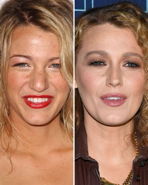 Before After Rhinoplasty Blake Lively Blake Lively Nose Nose Job Before After Rhinoplasty Blake Lively Blake Lively Nose Nose Job