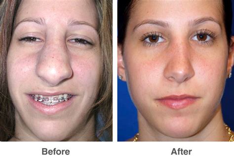 Best Plastic Surgeons When It Comes To Nose Surgery Aka Best Plastic Surgeons When It Comes To Nose Surgery Aka