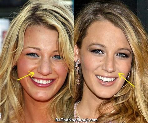 Blake Lively Before Nose Job Blake Lively Before Nose Job