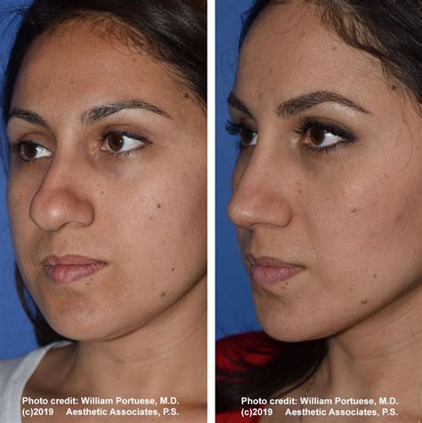 Bulbous Nose Job Before And After