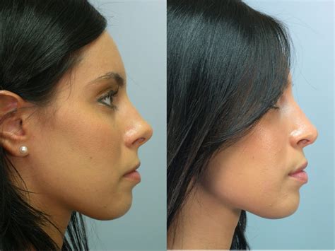 Cost Of Nose Job