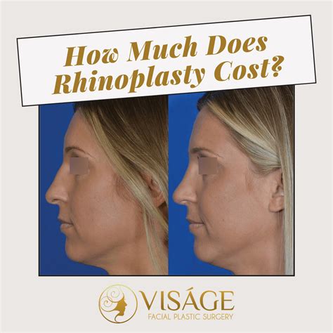 Cost Of Types Of Nose Jobs Julio Bolton Cost Of Types Of Nose Jobs Julio Bolton
