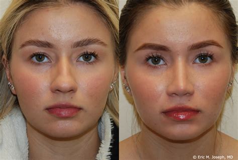 Good Nose Job Before And After Good Nose Job Before And After