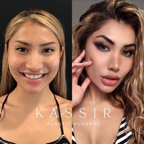 How Much Does A Nose Job Or Rhinoplasty Cost How Much Does A Nose Job Or Rhinoplasty Cost