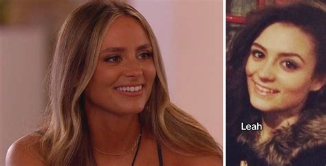 Leah Love Island Nose Job