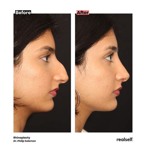 Rhinoplasty The Ultimate Guide To A Nose Job Realself Rhinoplasty Rhinoplasty The Ultimate Guide To A Nose Job Realself Rhinoplasty