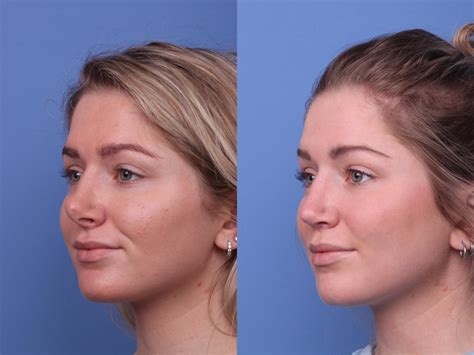 Surgery Nose Jobs
