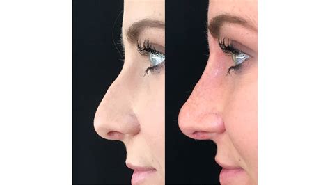 Types Of Permanent Non Surgical Nose Jobs Stash Magazine Types Of Permanent Non Surgical Nose Jobs Stash Magazine
